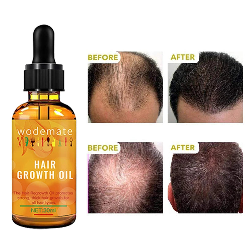 Ginger Hair Growth Serum Essential Oil Anti Hair Loss Fast Grow Hair Growth Oil Essential Oil Treatments Health Care Beauty 30ml